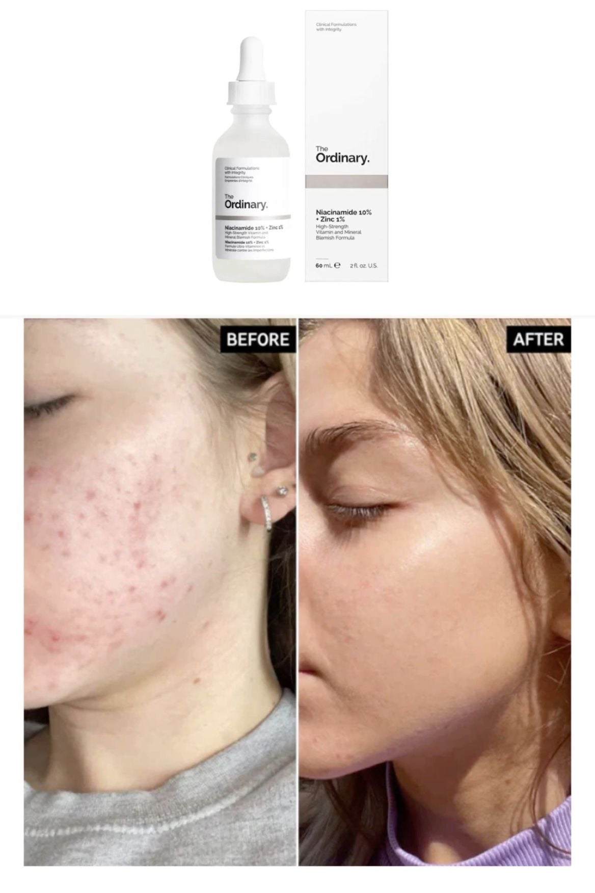 💧 The Ordinary Niacinamide 10% + Zinc 1%